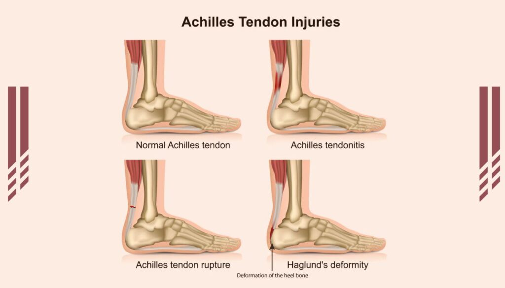 Insoles for Achilles Tendonitis
